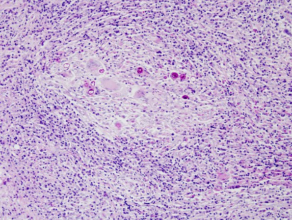 3A1 Coccidioidomycosis (Case 3) PAS 3