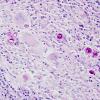 3A2 Coccidioidomycosis (Case 3) PAS 4