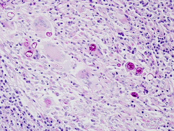 3A2 Coccidioidomycosis (Case 3) PAS 4