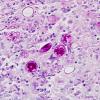 3A3 Coccidioidomycosis (Case 3) PAS 7