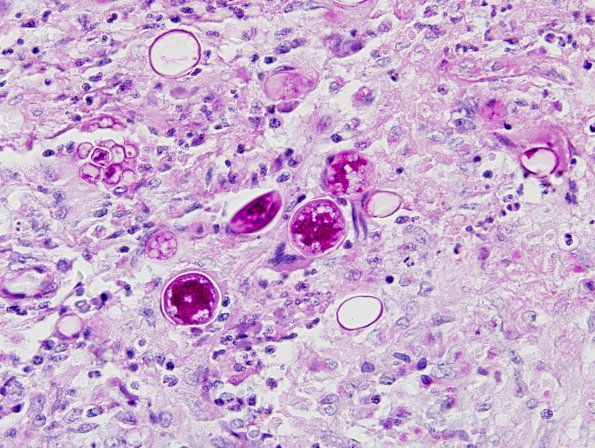 3A3 Coccidioidomycosis (Case 3) PAS 7