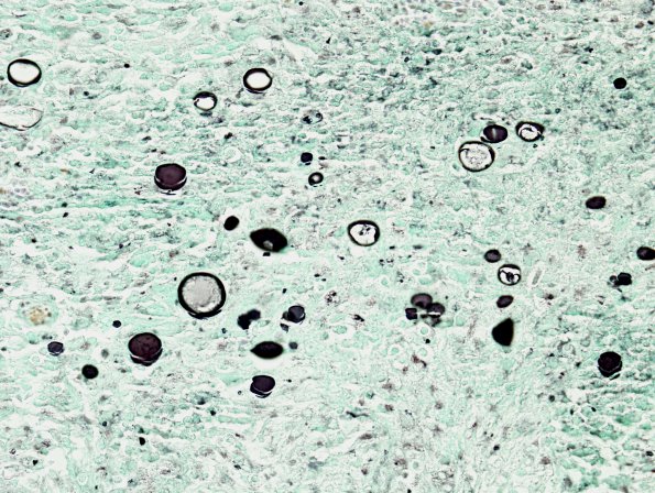 3A4 Coccidioidomycosis (Case 3) GMS 1