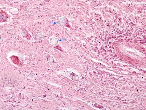 4 Coccidioides, leptomeninges (Case 4) H&E copy