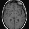 10A1 Cryptococcal meningitis (Case 10) T1 TRAN SE - Copy