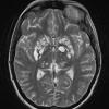 10A2 Cryptococcal meningitis (Case 10) T2 TSE 1 - Copy