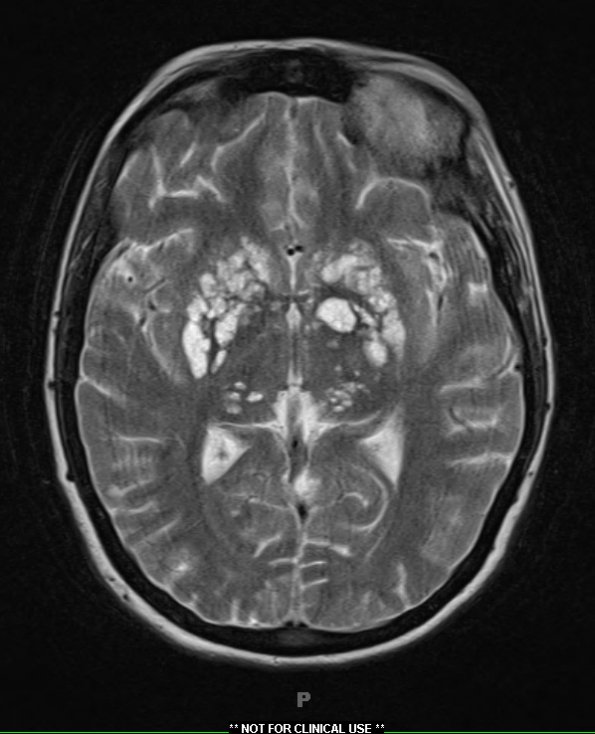 10A2 Cryptococcal meningitis (Case 10) T2 TSE 1 - Copy