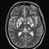 10A3 Cryptococcal meningitis (Case 10) T2 1 - Copy