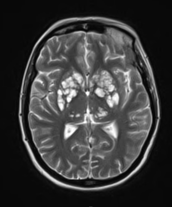 10A3 Cryptococcal meningitis (Case 10) T2 1 - Copy