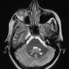 10A4 Cryptococcal meningitis (Case 10) T2 2 - Copy