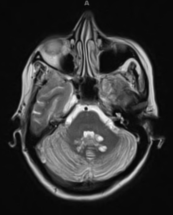 10A4 Cryptococcal meningitis (Case 10) T2 2 - Copy