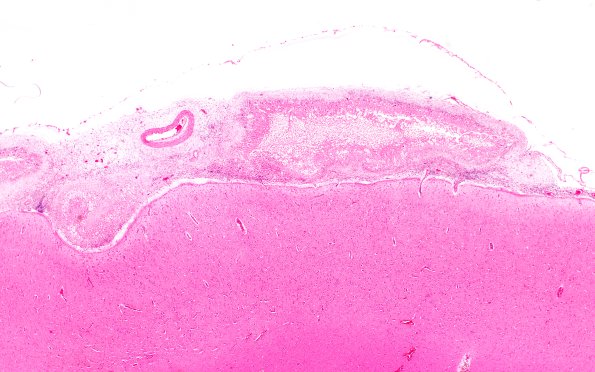 10B2 Cryptococcus (Case 10) H&E 2X