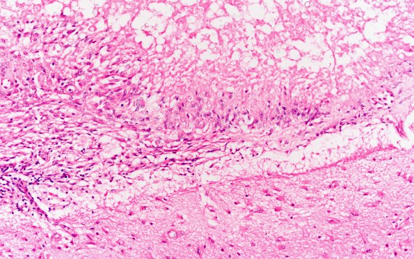 10B4 Cryptococcus (Case 10) H&E N1A 20X