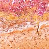 10C4 Cryptococcus (Case 10) Mucicarmine N1A 20X