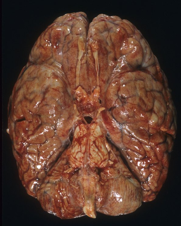 1A1 HIV, vacuolar myelopathy, cryptococcus (Case 1) 1