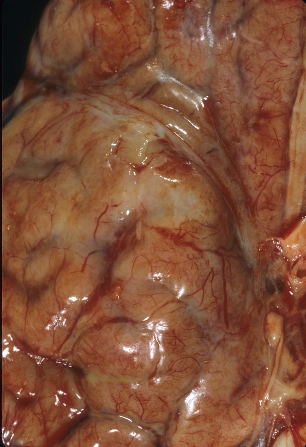 1A3 HIV, vacuolar myelopathy, cryptococcus (Case 1) 16