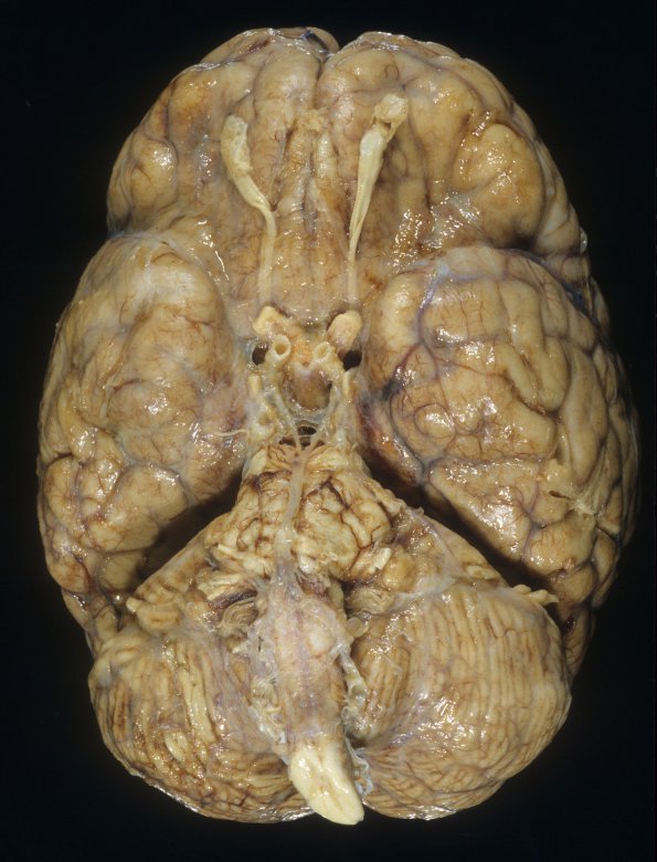 1A5 HIV, vacuolar myelopathy, cryptococcus (Case 1) 15