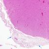 1B1 Cryptococcal Meningitis (Case 1) H&E 1 copy