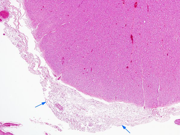 1B1 Cryptococcal Meningitis (Case 1) H&E 1 copy