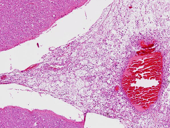 1B2 Cryptococcus (Case 1) H&E 1