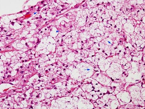 1B3 Cryptococcus (Case 1) H&E 2 copy