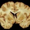 1 Cryptococcal Meningitis