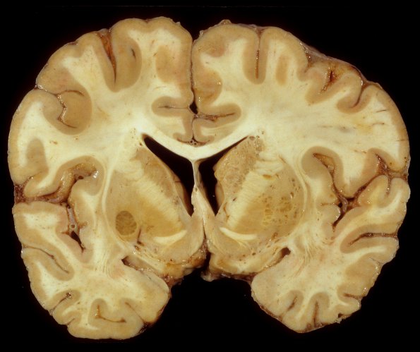 1C1 HIV, vacuolar myelopathy, cryptococcus (Case 1) 7