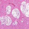 1D2 Cryptococcus (Case 1) H&E  1 copy