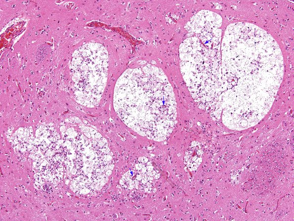 1D2 Cryptococcus (Case 1) H&E  1 copy