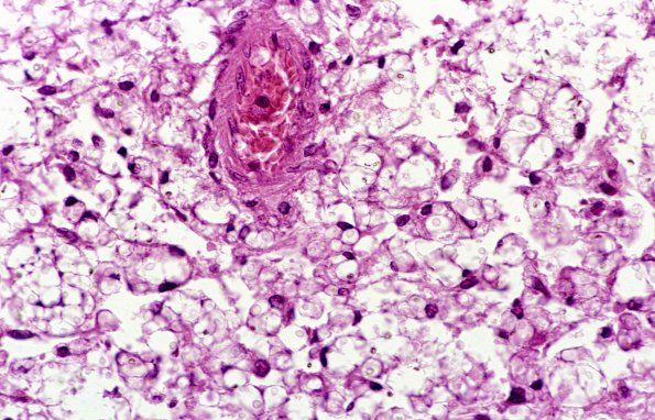 1D3 Cryptococcus (Case 1) 12