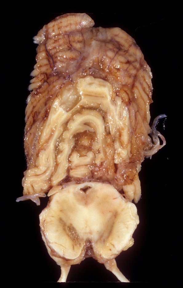 1E1 HIV, vacuolar myelopathy, cryptococcus (Case 1) 3A