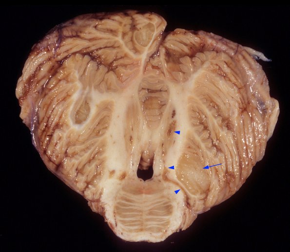 1E2 HIV, vacuolar myelopathy, cryptococcus (Case 1) 4 copyA