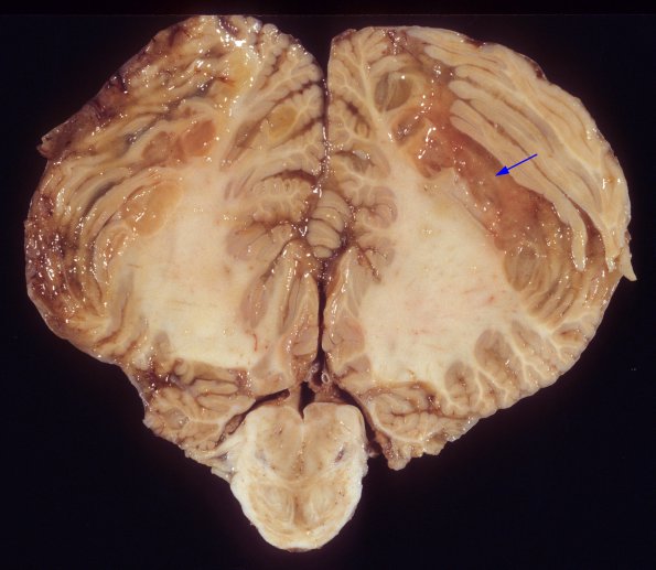 1E3 HIV, vacuolar myelopathy, cryptococcus (Case 1) 5 copyA