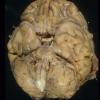 2A Meningitis, cryptococcus (Case 2) 2 (2)