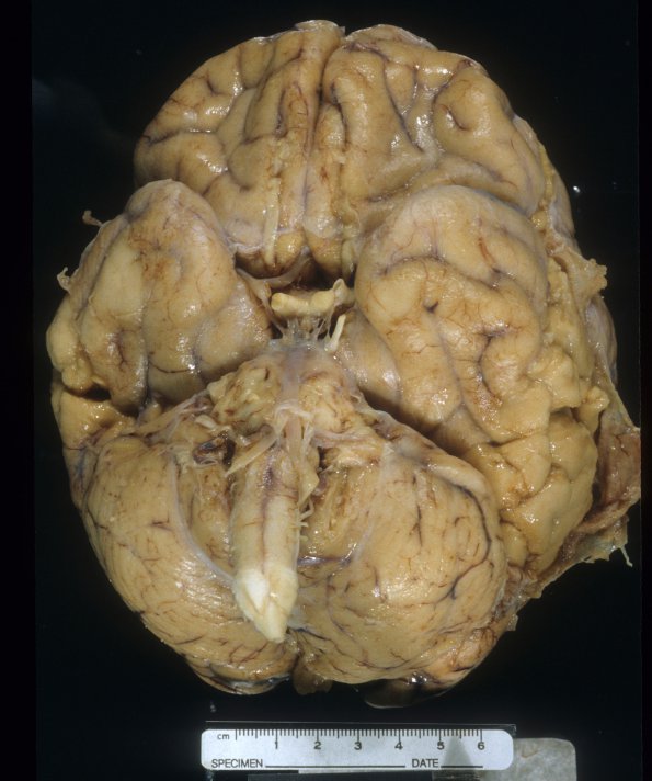 2A Meningitis, cryptococcus (Case 2) 2 (2)