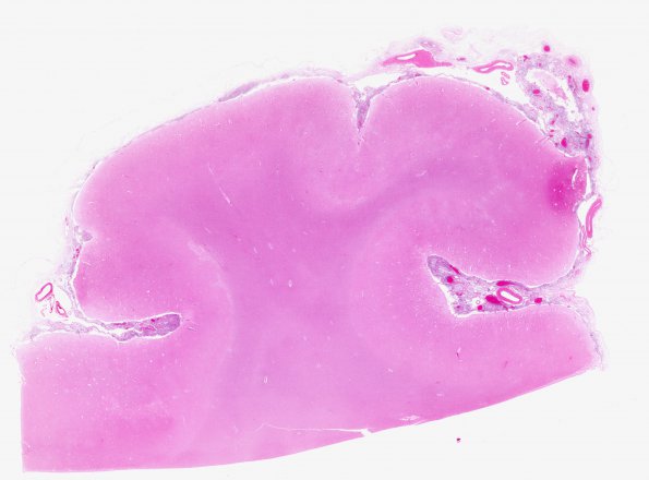 2B1 Cryptococcus, meningitis (Case 2) H&E whole mount