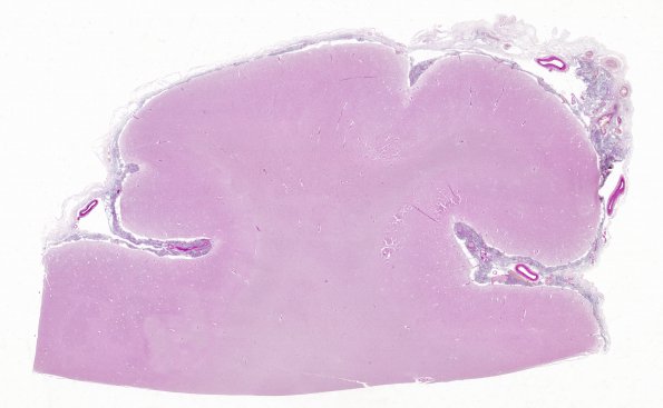 2B2 Cryptococcus, meningitis (Case 2) PAS whole mount