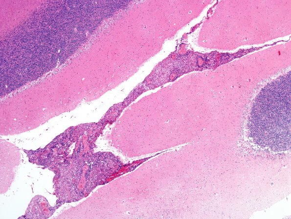 2C1 Cryptococcus (Case 2) 4