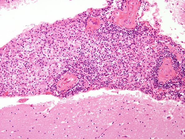 2C2 Cryptococcus (Case 2) 3A