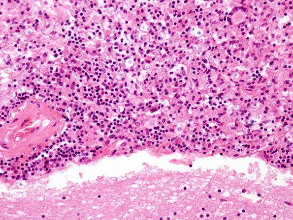 2C3 Cryptococcus (Case 2) 2A