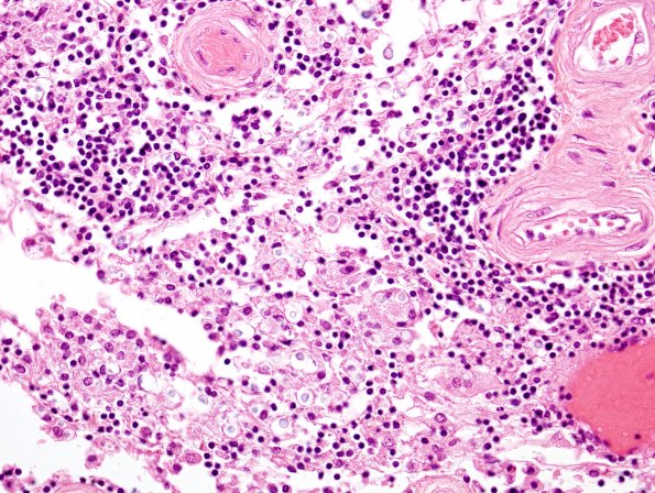 2C4 Cryptococcal Meningitis (Case 2) H&E 1A