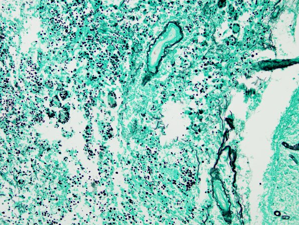 2D1 Cryptococcal Meningitis (Case 2) GMS