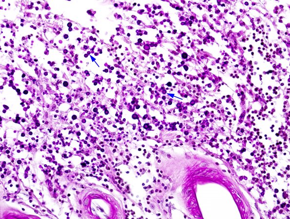 2D2 Cryptococcal Meningitis (Case 2) PAS 1 copy