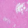 3A2 Cryptococcus (Case 3) H&E 9