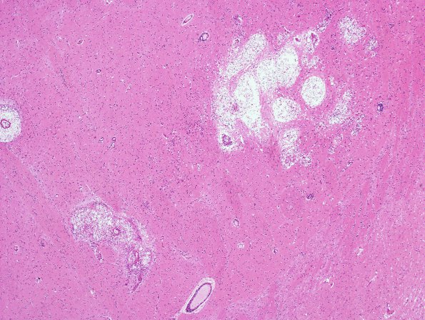 3A2 Cryptococcus (Case 3) H&E 9