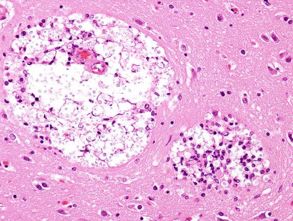 3A3 Cryptococcus (Case 3) H&E 6