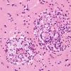 3A4 Cryptococcus (Case 3) H&E 2