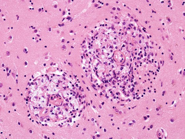 3A4 Cryptococcus (Case 3) H&E 2