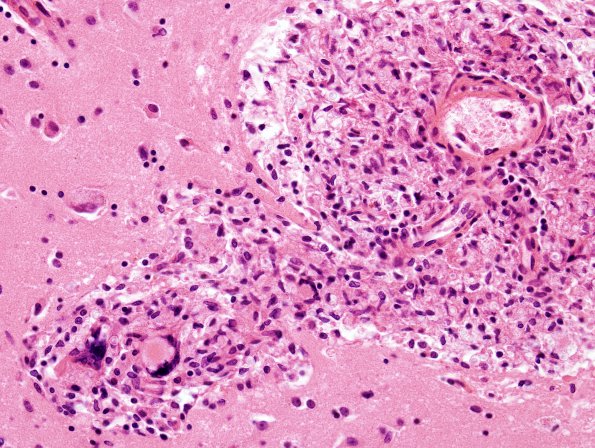 3A5 Cryptococcus (Case 3) H&E 3