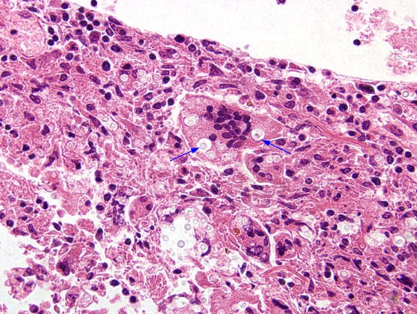 3A6 Cryptococcus (Case 3) H&E 7 copy