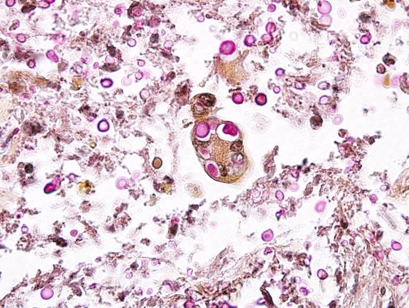 3B2 Cryptococcus (Case 3) Mucicarmine 1